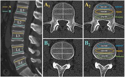 Hounsfield unit for assessing bone mineral density distribution within lumbar vertebrae and its clinical values